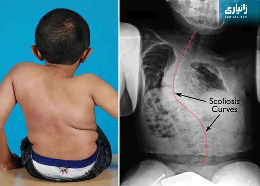 ئێسکەنەرمە - osteogenesis Imperfecta